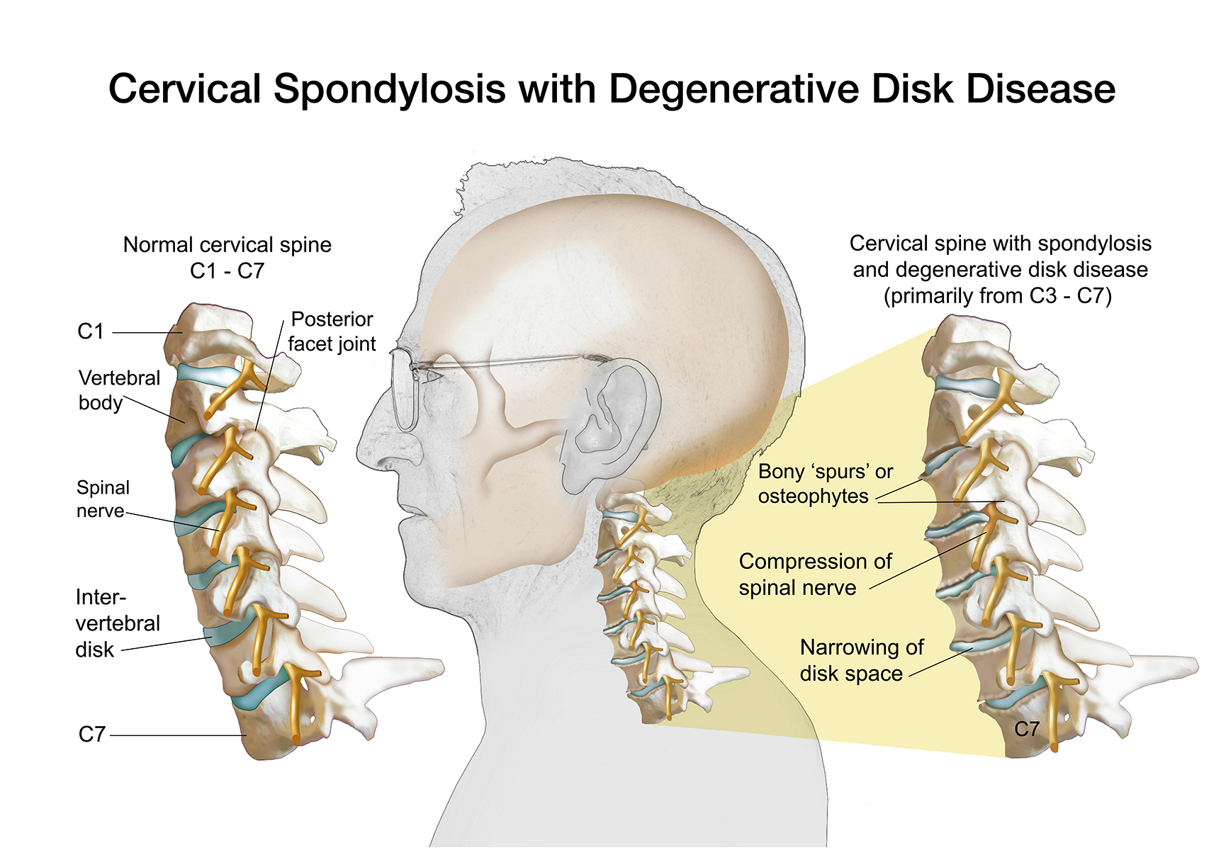 Cervical Degenerative Disk Disease Archives Jackie Heda Biomedical