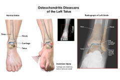 Osteochondritis Dissecans Injury
