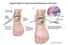 Osteochondritis Dissecans Surgical Procedure