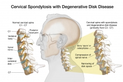 Cervical Spondylosis