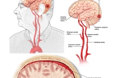 Occipital Hemorrhage