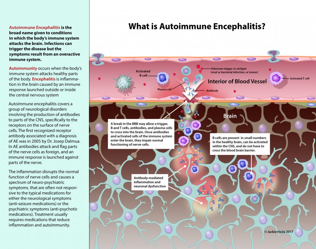 What is autoimmune encephalitis jackie heda biomedical